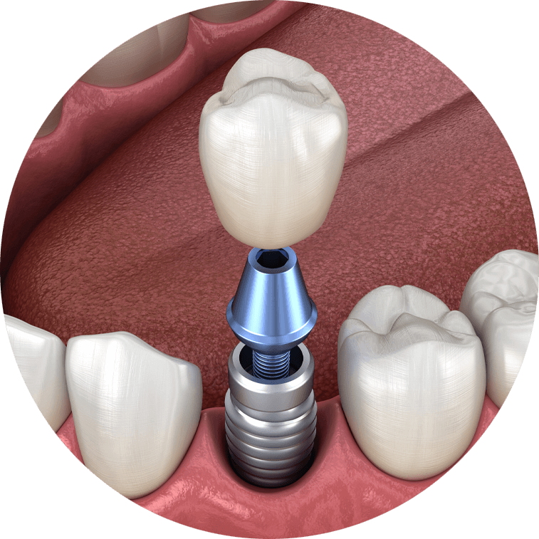 dental implants model.