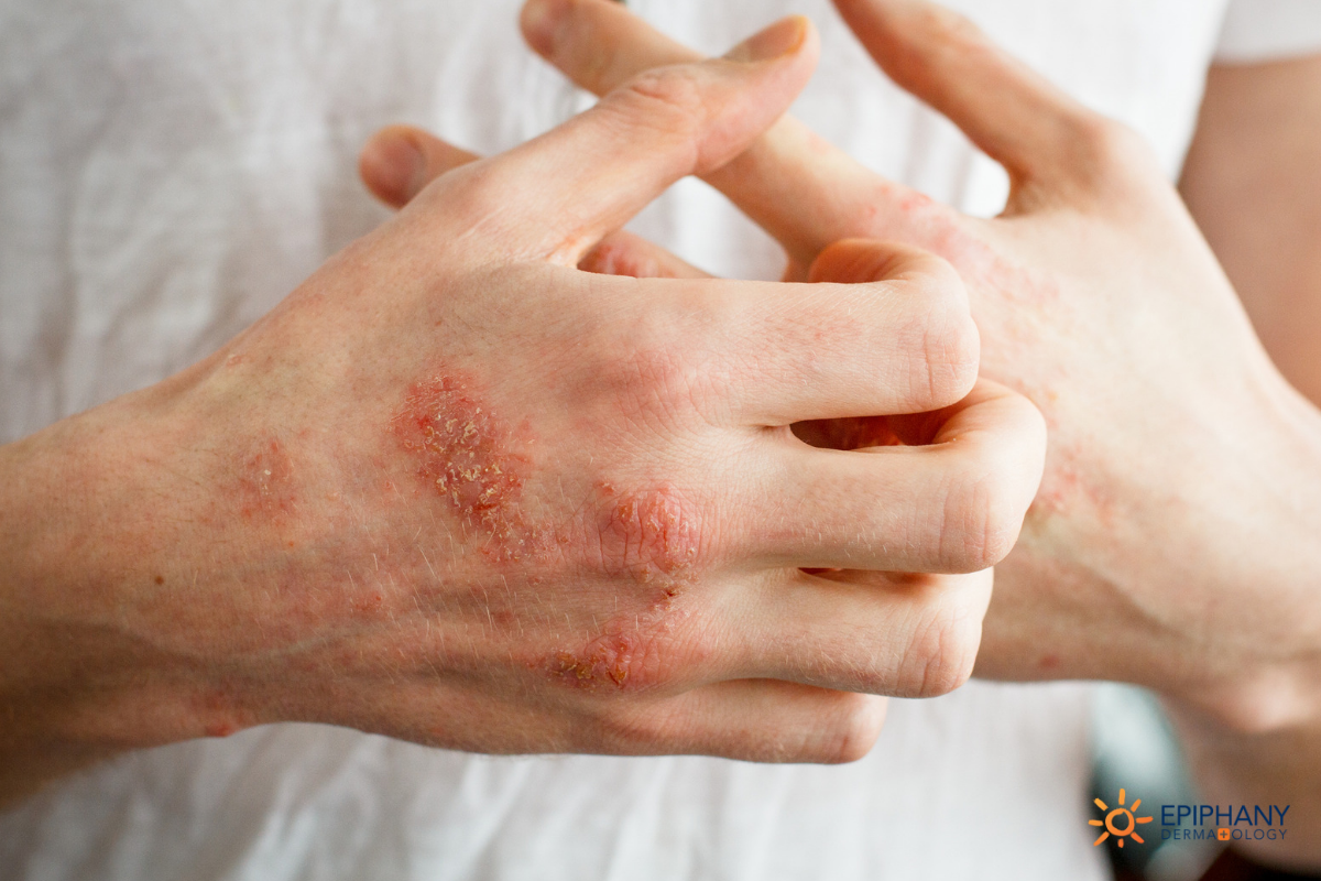 Red, Scaly Rash? Here's Why You Need A Dermatologist to Diagnose You