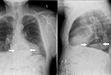 Simple Test Can Reveal More Hiatal Hernias - Gastroenterology ...