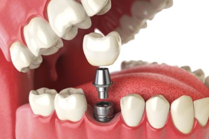 Dental implants Greensboro NC