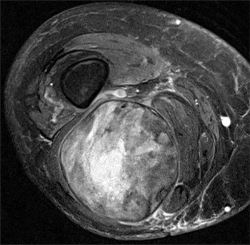 Sarcoma, Soft Tissue, Childhood - Pictures