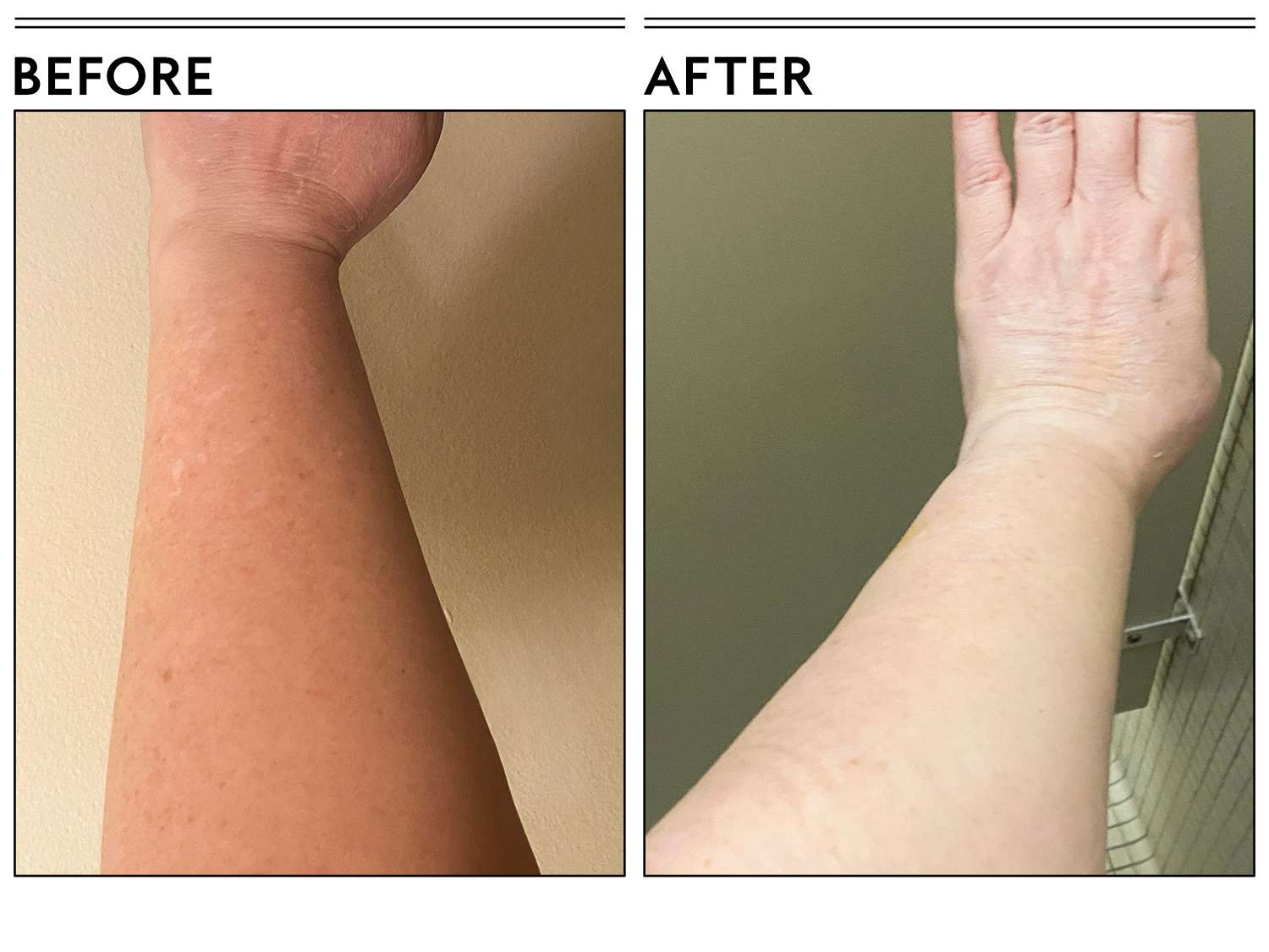 A before and after photo showing the effects of using Aveeno Daily Moisturizing Body Wash on a person's arm