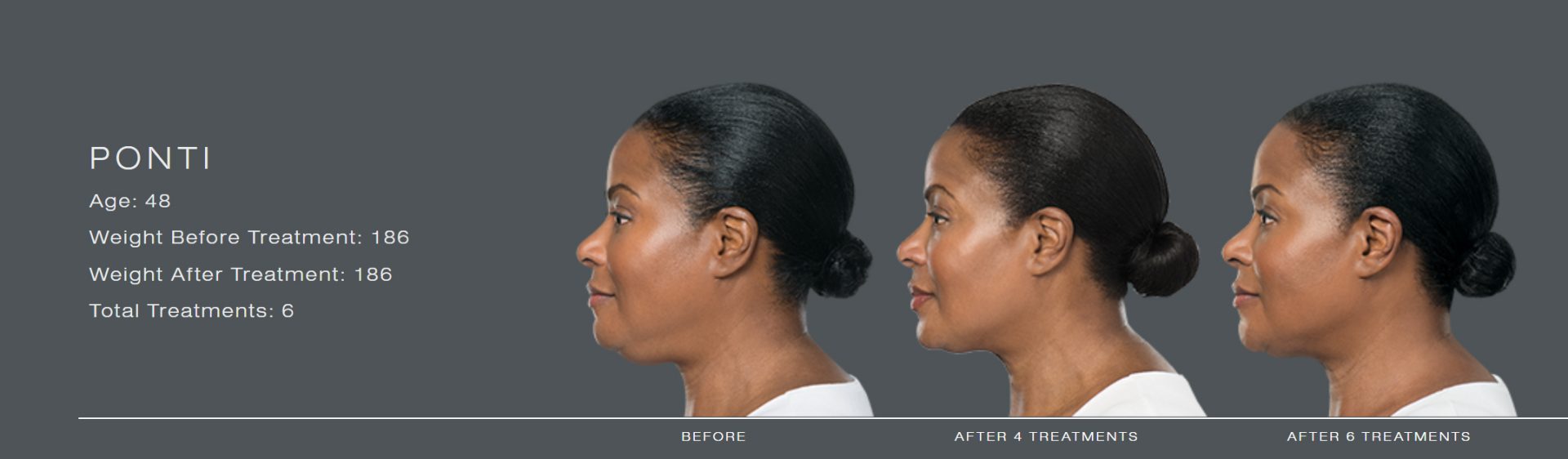 Kybella Chin Fat Reduction