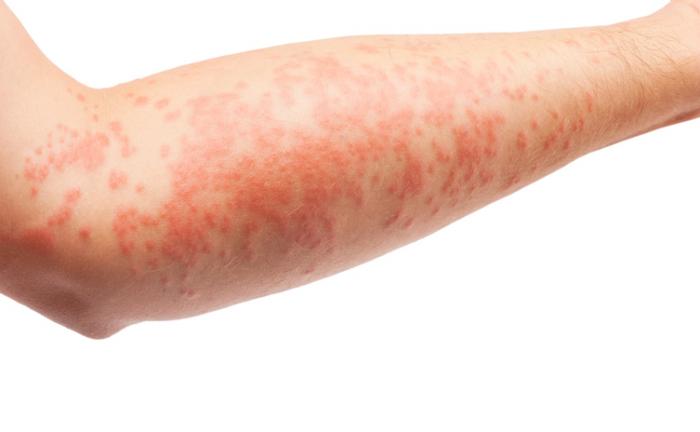 Common skin rashes: Pictures, causes, and treatments - Medical News Today