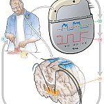 Drawing of a patient with a deep brain stimulation device as they prepare food in the kitchen