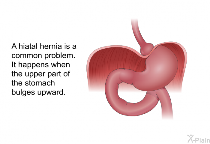 PatEdu.com : Hiatal Hernia