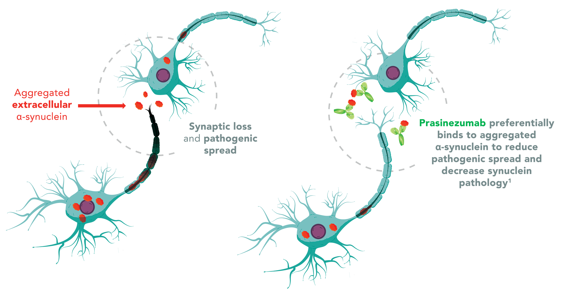 Parkinson's Disease