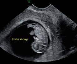 9 week ultrasound