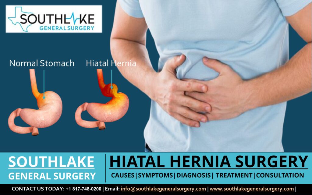 Here’s A Quick Way To Solve A Info About How To Fix Hiatal Hernia ...