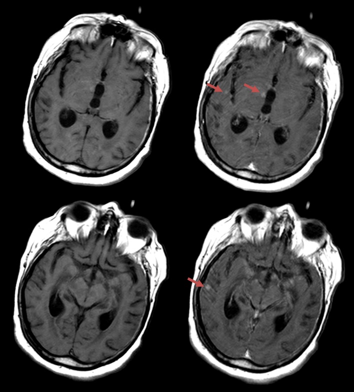 Gadolinium Mri