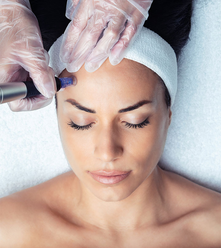 Benefits Of Microneedling For Acne Scars