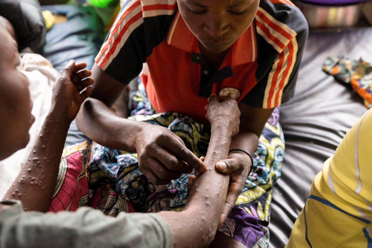 A woman pricks the rashes on her sister's arm to relieve pain inside a tent where she is undergoing treatment against mpox at the Kavumu hospital in Kabare territory, South Kivu province of the Democratic Republic of Congo, August 29, 2024. REUTERS/Arlette Bashiz