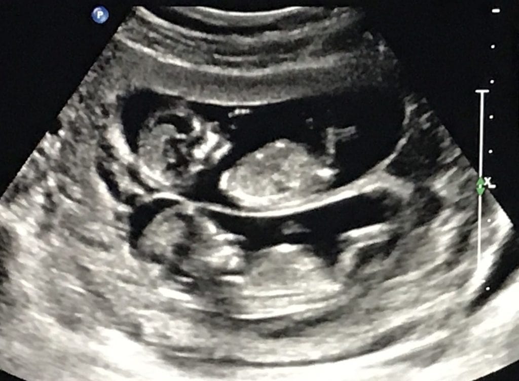 Identical Twins Ultrasound 12 Weeks