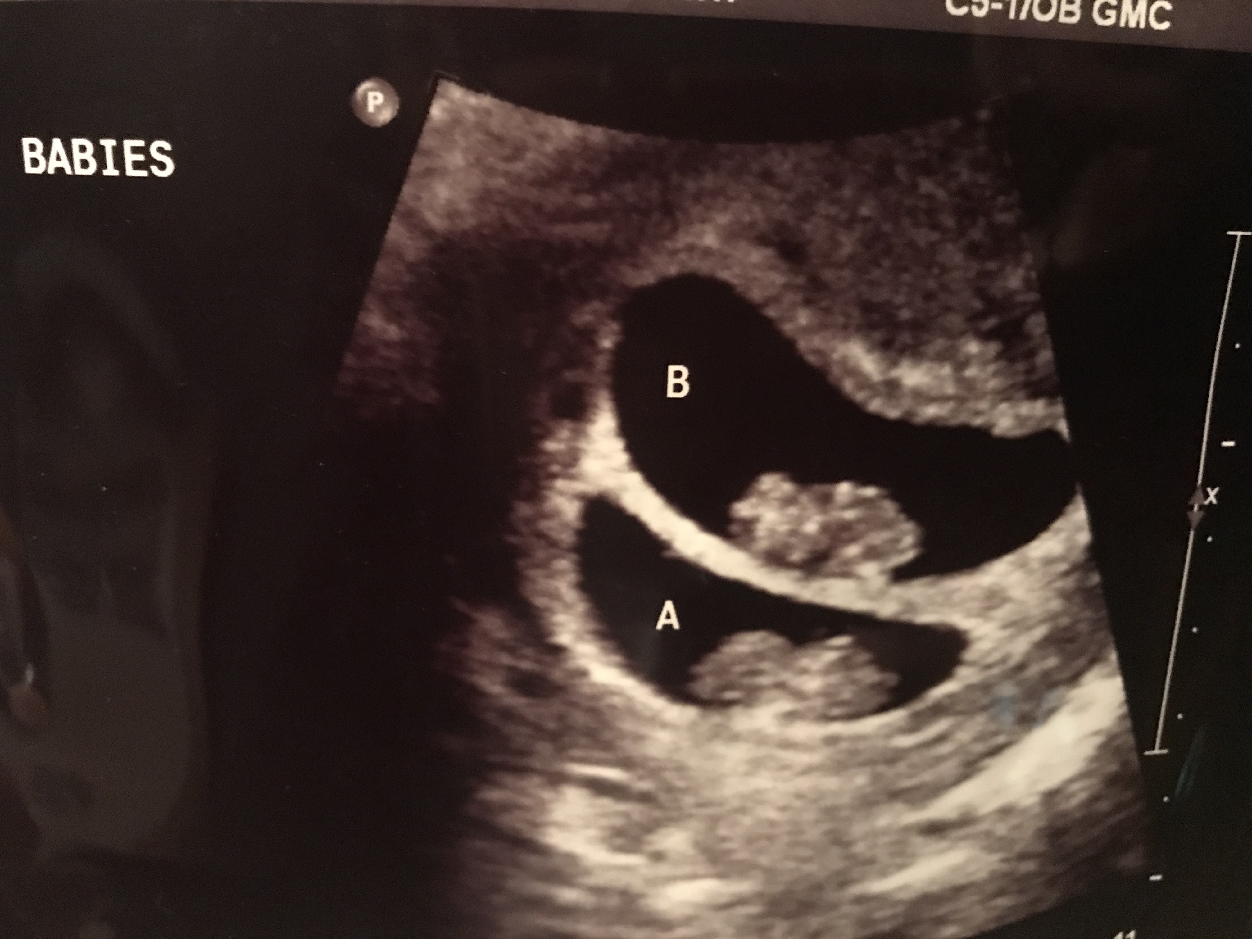 9 Weeks Pregnant With Twins Ultrasound Symptoms And Physical Acticity ...