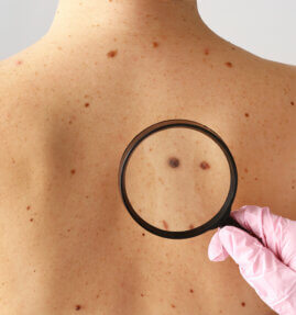 U.S. Dermatology Partners offers several skin cancer treatment options. Learn how to treat skin cancer and schedule a skin screening exam.