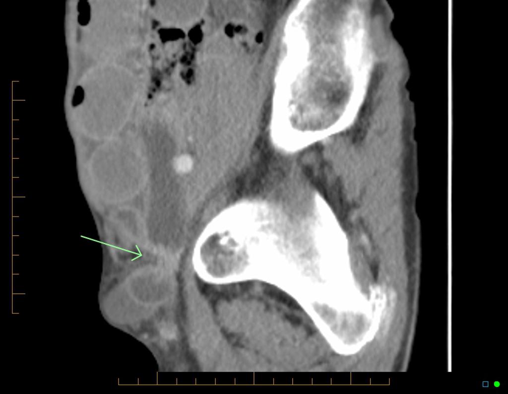 Femoral Hernia Diagram