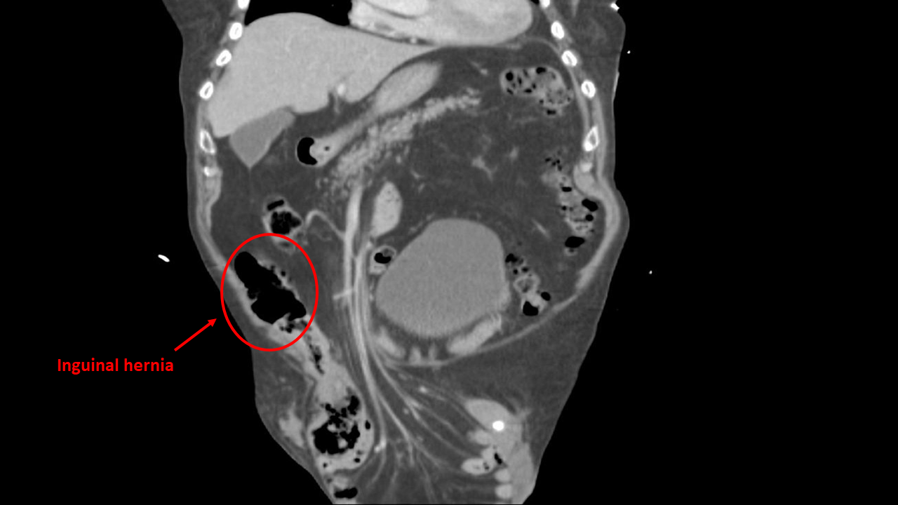 Inguinal Hernia CT Scan