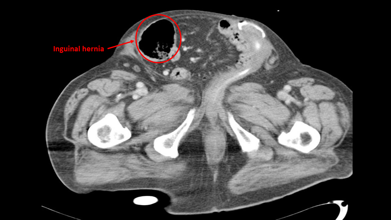 Inguinal Hernia CT Scan