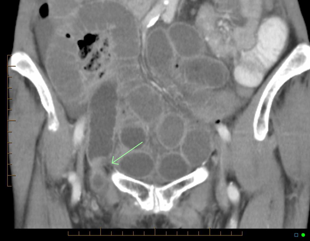 Femoral Hernia Diagram