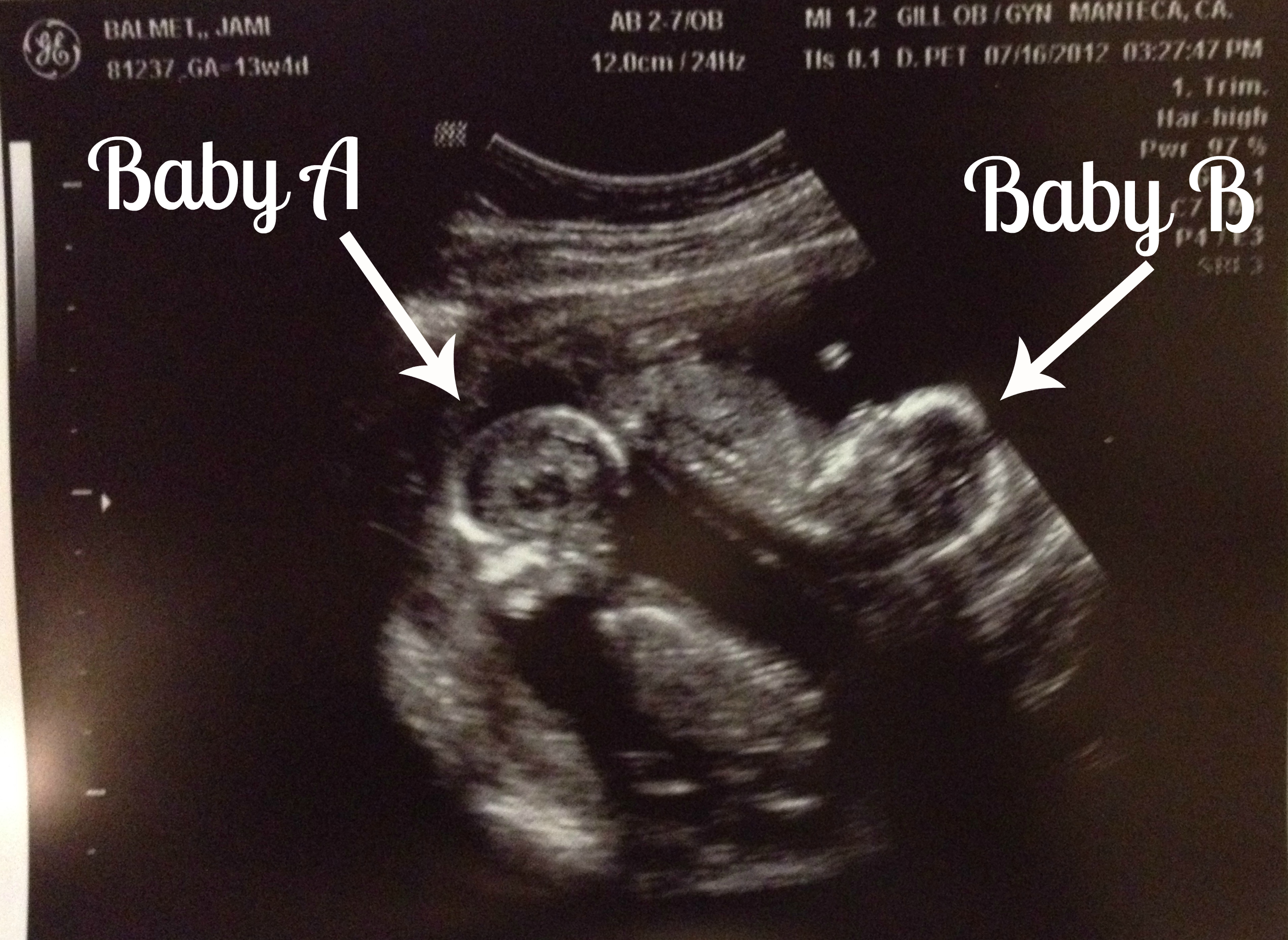 Identical Vs Fraternal Twins Ultrasound